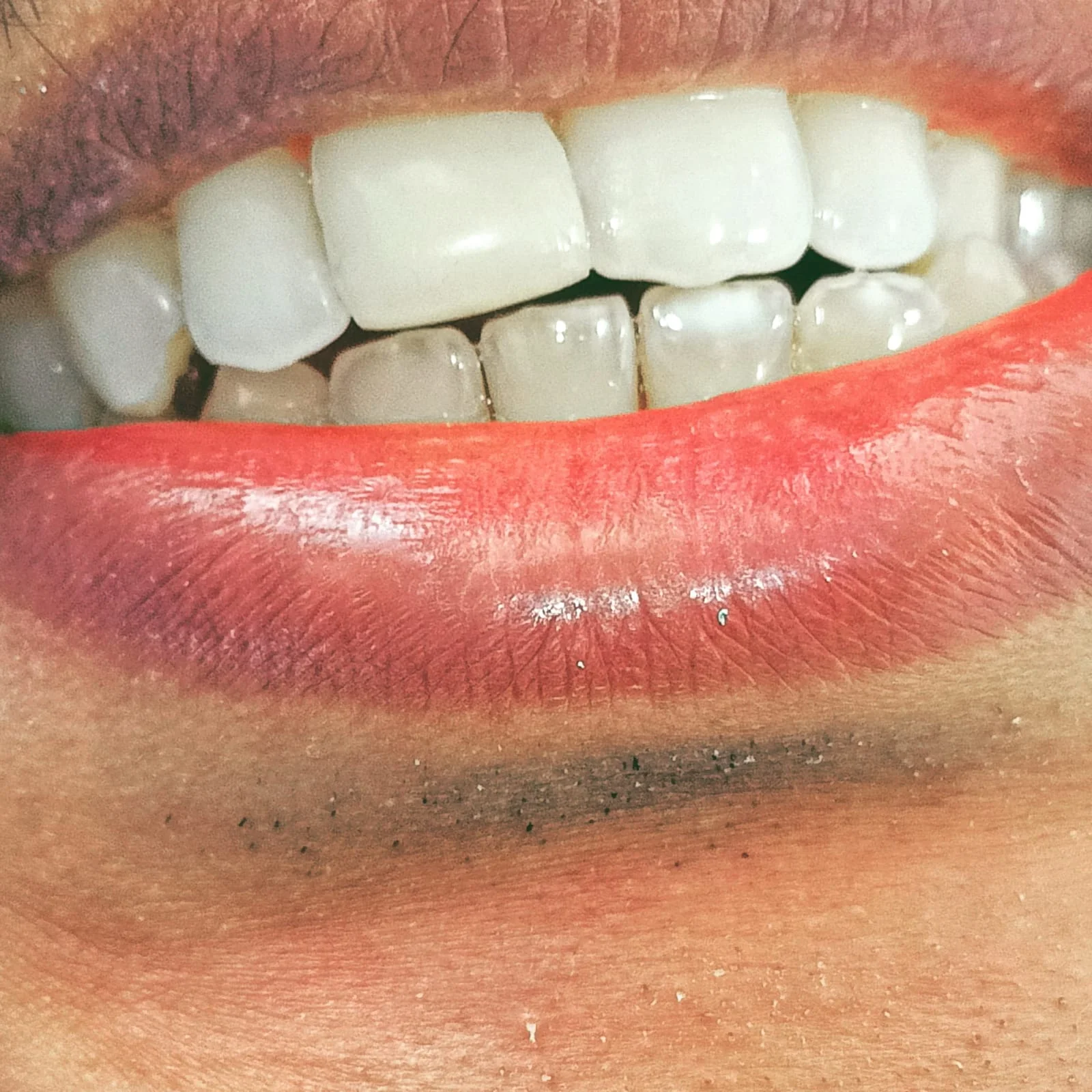 Anterior Smile Correction #6